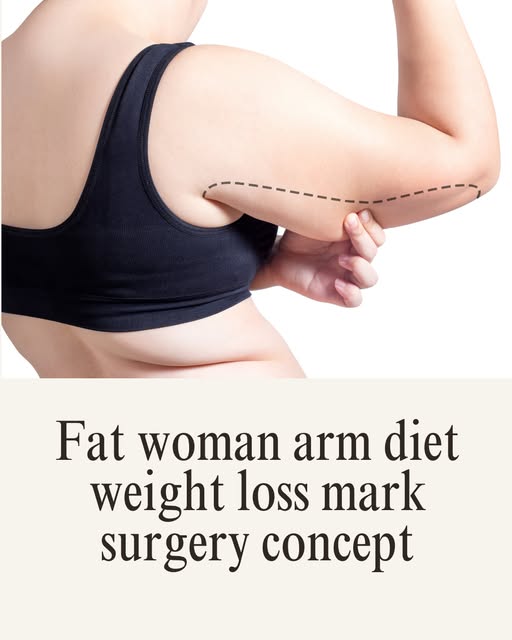 Say Goodbye to Bat Wings: The Art of Post-Weight Loss Arm Sculpting.

Losing weight is a massive vic