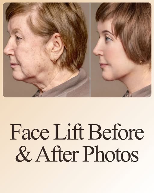 Face Lift Before & After Photos | Real Results & What to Expect.

Thinking about a facelift in Cairo