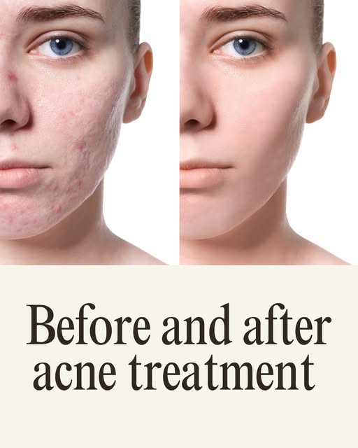 Clear Skin Starts Here: Acne & Scar Solutions at MSI Cairo.

Active acne and stubborn post-acne scar