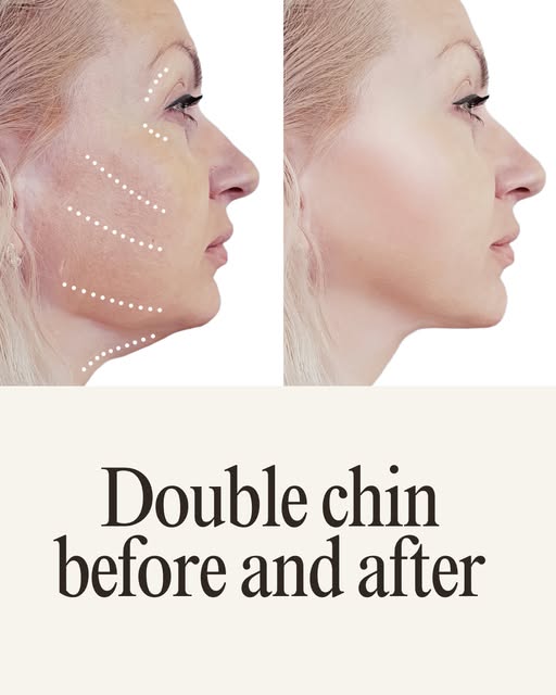 Double Chin Before & After.

Achieve a more defined and balanced facial profile with personalized do
