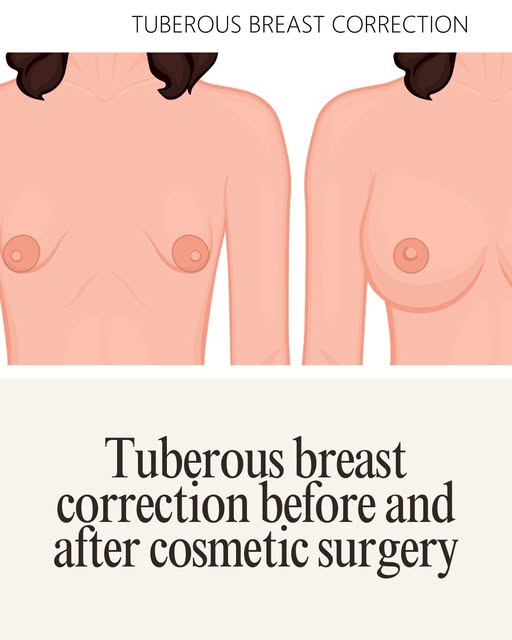 Transform your confidence with expert cosmetic care at Moawad Skin Institute (MSI) in Cairo.

Tubero