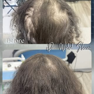 🧬 تقنية  Regenera كتعتمد على خلايا مجهرية مأخوذة من الجسم نفسه لإعادة تنشيط بصيلات الشعر بطريقة طبي