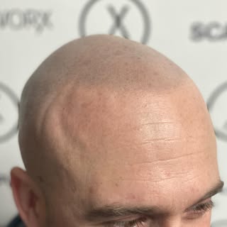 Great seeing a client after 1 year of healed treatment. It looks so fresh still. I did not even have
