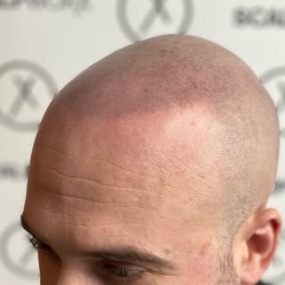 You got to love a completed treatment with a happy client no more baldness just the look of a natura