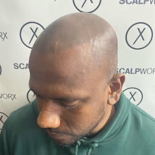 Great transformation today 3 year touch up on my treatment .
