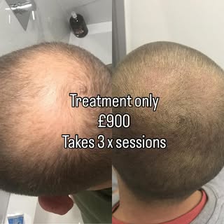 Our prices are affordable for this treatment. Book now . Tired of being bald and want to look younge