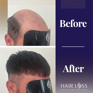 Another stunning hair system transformation, another ecstatic client! 
How natural does this look? �
