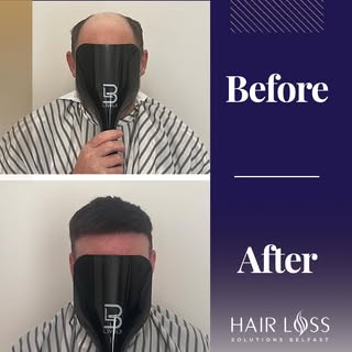 Hair Systems are soaring in popularity, offering amazing, transformative results. 
Want to know more