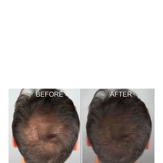 SMPTreatment is …
Solution for bald patches, thinning hair, receding hairline…
ink#tattoo#smp#dorset