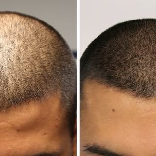 A hair tattoo or scalp micropigmentation (SMP for short) is a non-surgical, superficial cosmetic tat