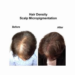This treatment is pain less. Good solution for hair loss, alopecia#comfidencewoman #women#hairloss