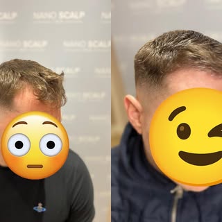 Density SMP treatment#
#scalptreatment #hairloss #hairtreatment #haircare #scalpmicropigmentation #h