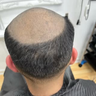 We are restoring nature .  Going bald isn’t a choice , staying bald is. Transformation by Joana ❤️

