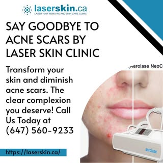 Say goodbye to acne scars with our advanced laser treatments. Our clinic specializes in creating smo
