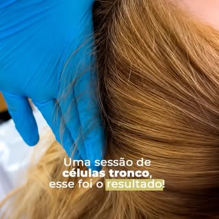 Sim! Esse são fios novos! 😍
Com apenas uma sessão de células-tronco, já é possível observar um cour