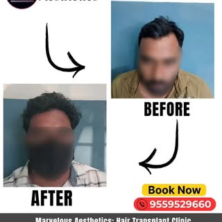 Kabhi purani photos dekh kar lagta hai - “Mere baal pehle kitne acche the…”?

Balding se confidence 