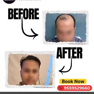 Do you miss combing your hair? get the best solution with our hair transplant. consult now.
Consult 