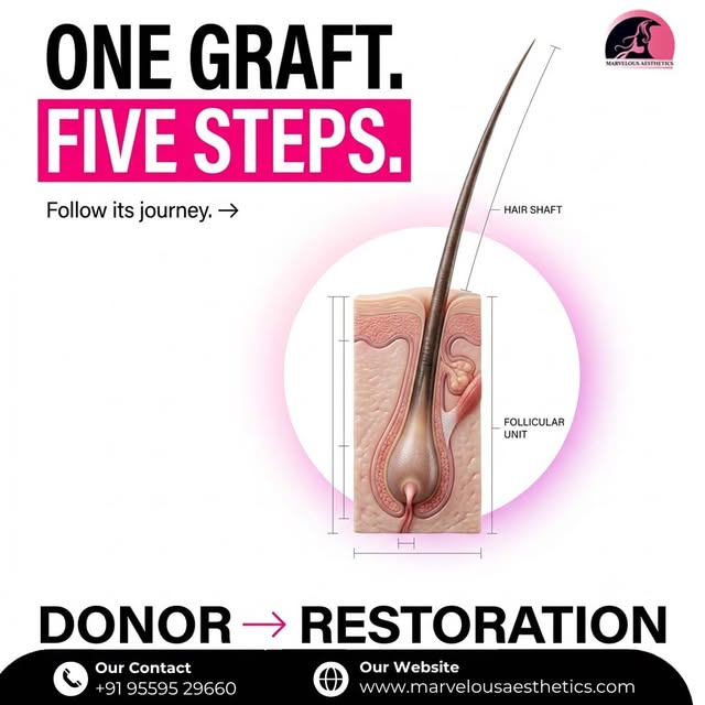 One graft. Five carefully considered steps. 🧬

A hair transplant isn’t simply about moving hair fro