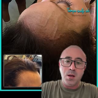 We are the leaders of Scalp Micropigmentation in the Tampa area for Women’s hair loss, message for a