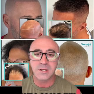 Free Scalp Micropigmentation consultation. #smptampa