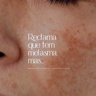O melasma é uma condição crônica e multifatorial e isso significa que não existe um único produto ou