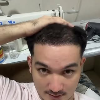 After 4 months, our patient @emmanzeidenberg is so happy with his hair transplant results! 👏🏼 His 
