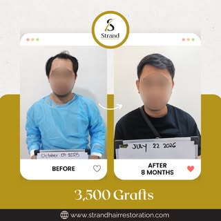 A restored hairline changes more than just your look; it brings back your natural confidence. Check 