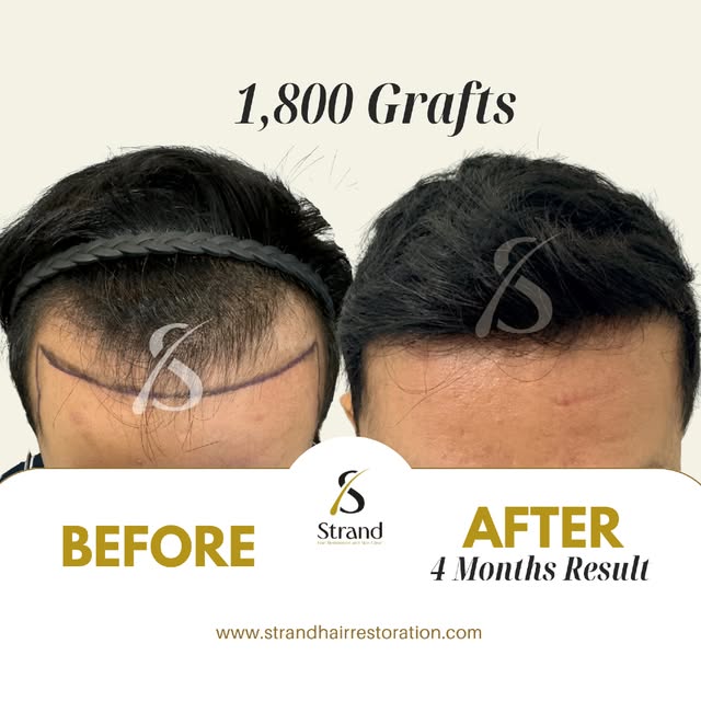 BEFORE and AFTER | Check out this incredible result! ✨

📩 Book a free online consultation! 
📳 Cont