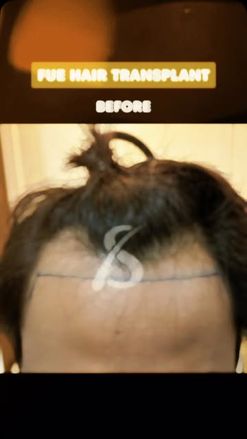 FUE Hair Transplant | Results After 5 Months

#fuehairtransplant #hairtransplant #hairtransplantmen 