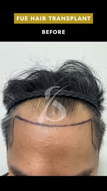 FUE Hair Transplant Before and After 5 Months 2,500 Grafts

Check out this incredible result! ✨
#fue