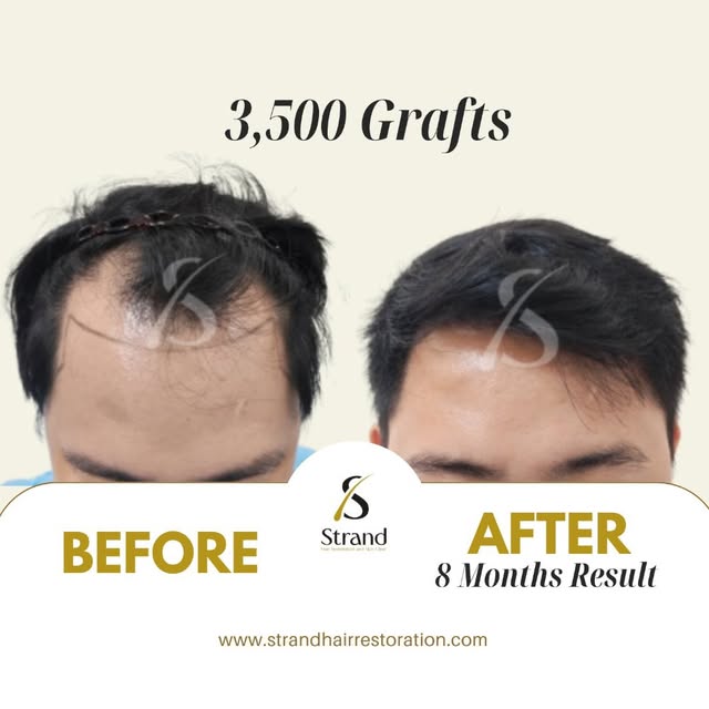 BEFORE and AFTER | Check out this incredible result! ✨
📩 Book a free online consultation! 
📳 Conta