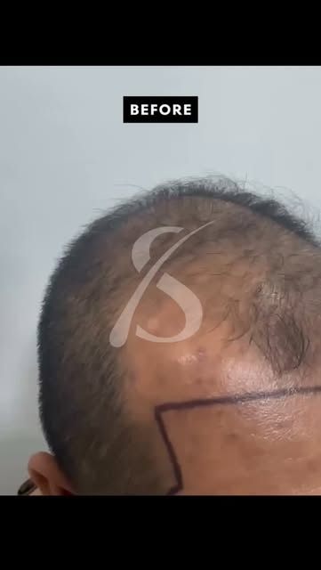 🚨 REAL RESULTS. REAL CONFIDENCE. 💥
✅ 3,500 Grafts Transplanted
⏳ Only 5 Months In — and it's alrea