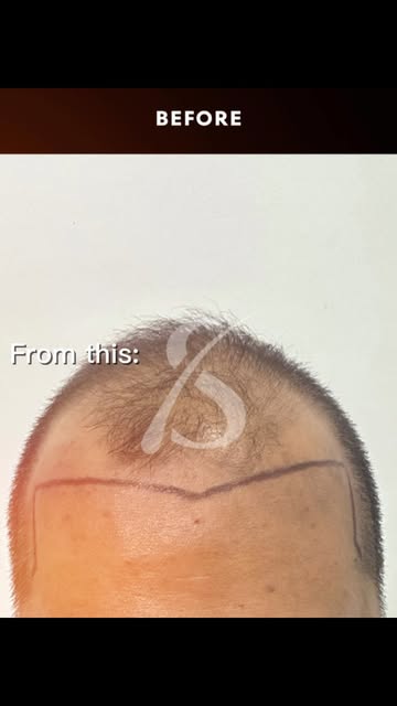 FUE Hair Transplant | Results After 5 Months

#fuehairtransplant #hairtransplant #hairtransplantmen 
