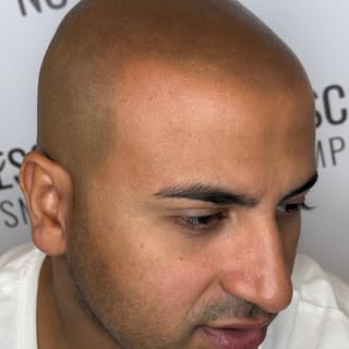 Questa è una trasformazione incredibile! Bellissimo risultato con una linea frontale molto naturale 