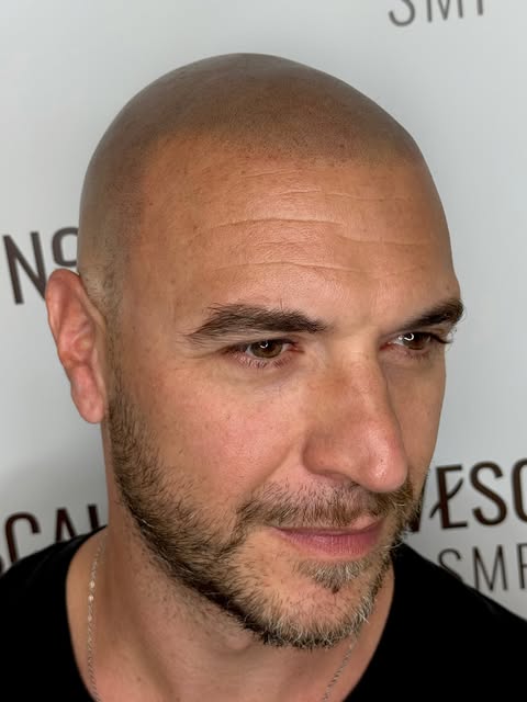 Una nuova hairline può cambiare completamente un volto. ✨
Più giovane, più definito… semplicemente l