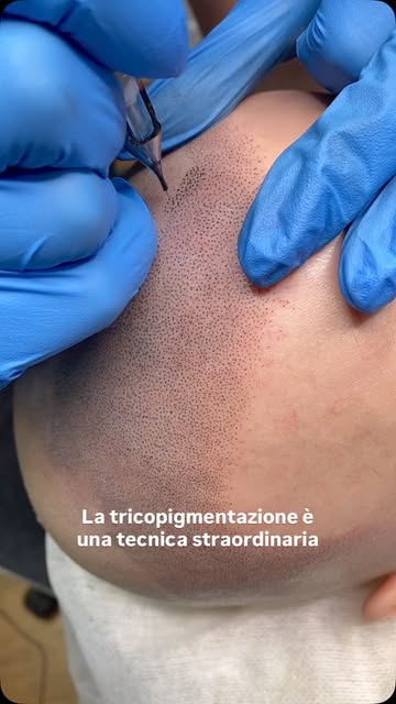 HAI PERSO LA TUA ATTACCATURA DEI CAPELLI?
Possiamo ricrearla. Senza chirurgia. ✨

La tricopigmentazi