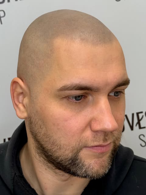 HEALED result after 9 months 

▫️▫️▫️

risultato GUARITO dopo 9 mesi 

#scalpmicropigmentation #scal