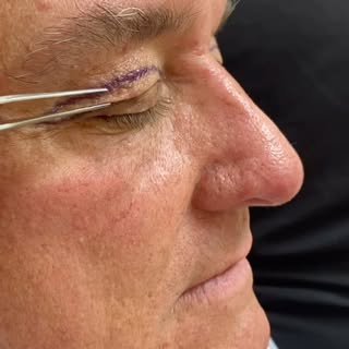 Bright-eyed and refreshed! ✨ Watch this incredible transformation with our live before-and-after Ble