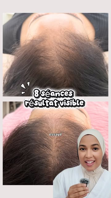 8 séances de hair needling. Et un résultat qu’elle n’osait plus espérer 🤍

Quand cette cliente a po