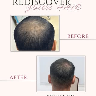 ✨ Your hair deserves a fresh start. ✨

From PRP Hair Therapy to Hair Transplantation, we offer perso