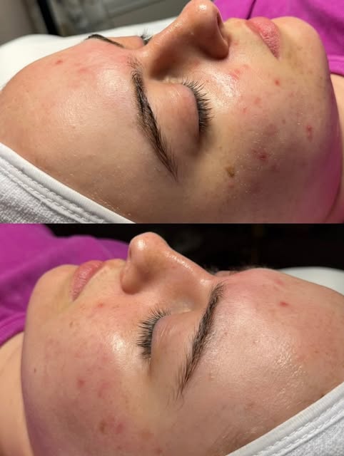 Consistency is key🔑. Monthly treatments and a personalized skincare routine is the first step in th