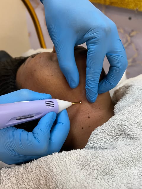 Liberte-se dos sinais indesejados! ✨ A derma HAIR + traz a solução ideal para uma pele renovada e ra