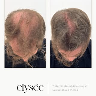 ✨ CIENCIA Y PRECISIÓN EN LA RESTAURACIÓN CAPILAR

En Clínica Elysée, la excelencia nace de un diagnó