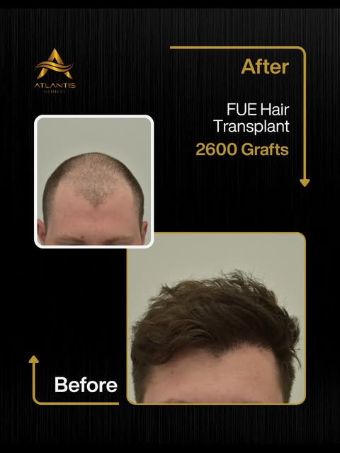 2600 GRAFTS | MALE FUE HAIR TRANSPLANT

This patient underwent a 2600 graft FUE hair transplant afte