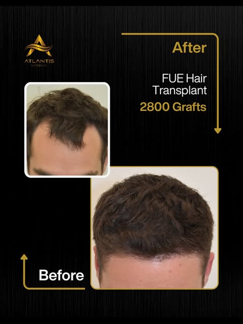 2800 GRAFTS | MALE FUE HAIR TRANSPLANT

This patient underwent a 2800 graft FUE hair transplant to a