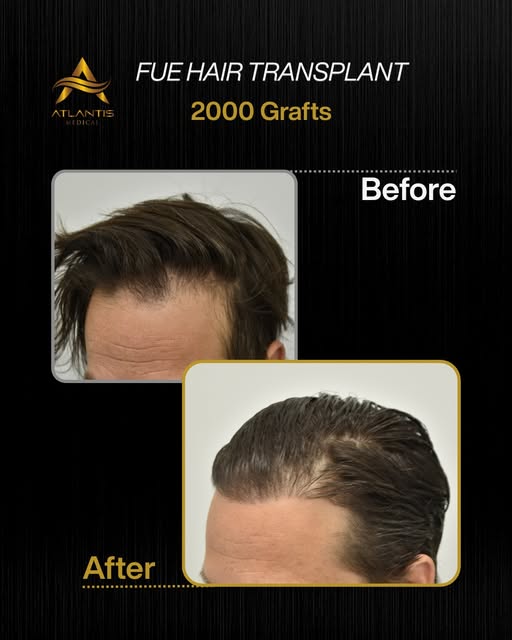 This patient had recession through the frontal hairline, with thinning continuing behind it across t