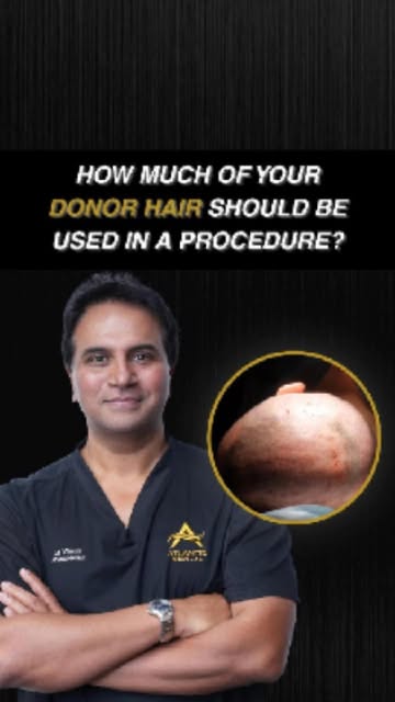 Donor hair is a finite resource. A hair transplant does not create new hair. It moves follicles from
