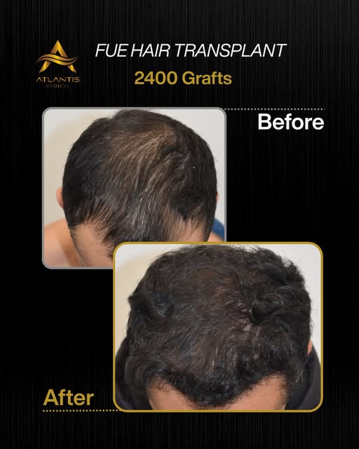 2400 GRAFTS | MALE FUE HAIR TRANSPLANT

This patient underwent a 2400 graft FUE hair transplant to a