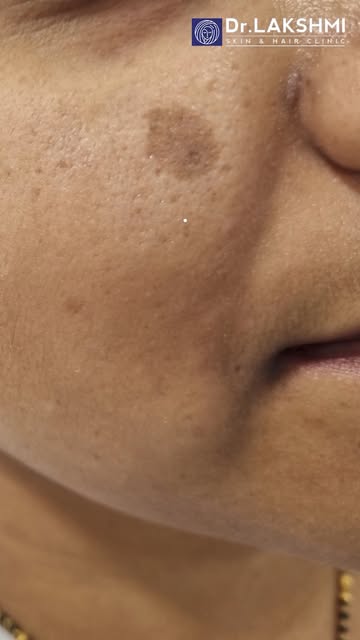 ✨ Noticing dark spots that weren’t there before?

Age spots are common areas of pigmentation that de