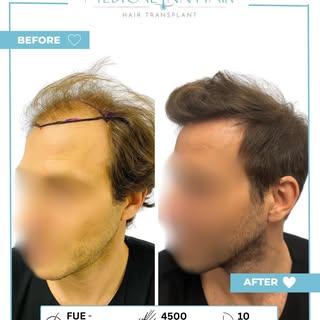 Man sieht nicht nur neue Haare. Man sieht neues Selbstbewusstsein ✨

10 Monate nach seiner Haartrans